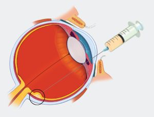 Auge erhält eine Injektion