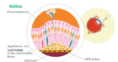 Applikation von Luxturna® in den subretinalen Raum 